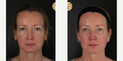 45-54 year old woman treated with PicoSure - Great 1 month results from the Halo treatment! Proven to reduce years of damage off the face!