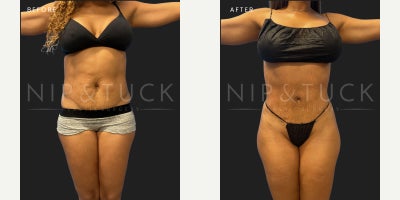34 year old woman treated with Lipo 360 - 43 years old female s/p lipo 360 Tumescence: 2830 ccLiposuction: Abdomen / flanks:1400 cc Back: 1400 ccProcedure taken:Liposuction of abdomen, flanks, and back10 months post-op