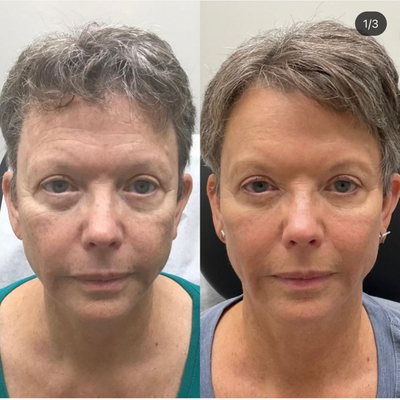 55-64 year old woman treated with Restylane Contour, Restylane Defyne, Dermal Fillers, Botox, Chin Filler, Cheek Fillers - Cheek, chin jawline filler and botox