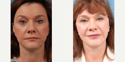 Woman treated with Lower Facelift - Woman treated with Lower Facelift