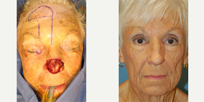 65-74 year old woman treated with Mohs Surgery - Mohs&nbsp;Surgery requires removing the cancerous tumor while maintaining the integrity and cosmetic appearance of healthy tissue and skin.