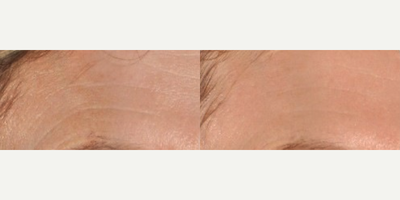Infini RF - Photo provided courtesy of Lutronic, performed by Steven F. Weiner, MD