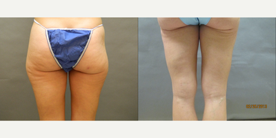 35-44 year old woman treated with Liposuction - This patient had liposuction to the outer thighs.