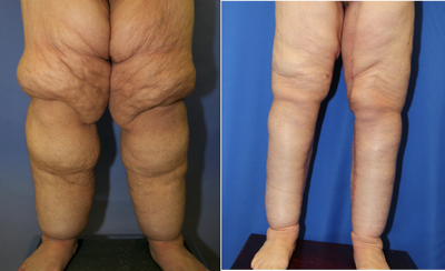 Thigh Lift 18 - This is a 47 year old female who weighed 443 lbs. &nbsp;She had gastric bypass surgery and lost 230 lbs. &nbsp;After weight loss, she was not happy with her inner thighs. &nbsp;She underwent a spiral medial thigh lift/reduction and calf reduction.