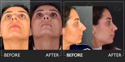25-34 year old woman treated with Rhinoplasty - Rhinoplasty
