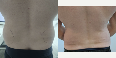 35-44 Man: 1 Month Semaglutide Back View Ozempic before and after transformation