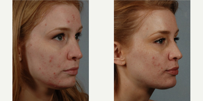 25-34 year old woman treated with Isolaz - Isolaz