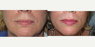 45-54 year old woman treated with Laser Resurfacing - Patient with upper lip lines . Fractional carbon dioxide laser resurfacing was used to treat these lines permanently.