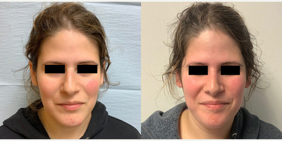 Rhinoplasty - Woman treated with Rhinoplasty