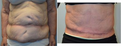 68 year old woman treated with panniculectomy along with abdominal wall reconstruction - Patient developed a recurrent hernia after an abdominal surgery in 2012. She then underwent gastric bypass in 2013 and lost over 80 pounds. In addition to the continued hernia, she had problems with irritation from excess skin. She elected to undergo abdominal wall reconstruction with ventral hernia repair with biologic mesh, component separation, and panniculectomy. (Note that the umbilicus was purposely sacrificed during the reconstruction)