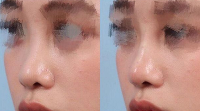 Woman treated with Restylane Lyft - Nonsurgical rhinoplasty with Restylane Lyft injection to nose