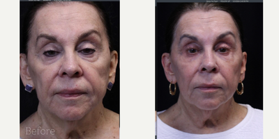 65-74 year old woman treated with Skin Rejuvenation, Nonsurgical Facelift, Nonsurgical Neck Lift, Laser Resurfacing, Fractional  - LASERCORING WITH ULTRACLEAR FULL FACE AND FULL NECK ONE SESSION AFTER 3 MONTHS