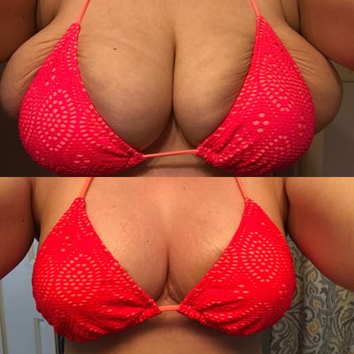 From 34J to 34D - Finally Got my Dream Breasts! - Review - RealSelf