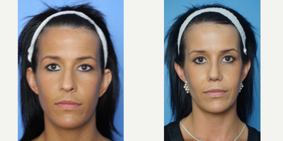 25-34 year old woman treated with Rhinoplasty - Refine meant of the tip with de-projerction and hump reduction