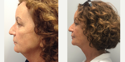 55-64 year old woman treated with FaceTite - Patient treated with FaceTite. 8 months post procedure