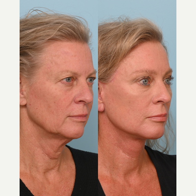 55-64 year old woman treated with Deep Plane Facelift, Neck Lift, Brow Lift, Double Eyelid Surgery, Facial Fat Transfer, CO2 Las - Not a new face, just a restored one!This transformation is all about lifting whats fallen, softening whats deepened, and bringing back the healthiest and most energetic version of yourself.Her procedure included a Preservation Deep Plane Facelift, Deep Vertical Neck Lift, 4-Point Brow Lift, Upper Blepharoplasty, CO2 Laser around the eyes, and Full Face Fat Transfer.The result is a smoother jawline, brighter eyes, and a refreshed version of her.