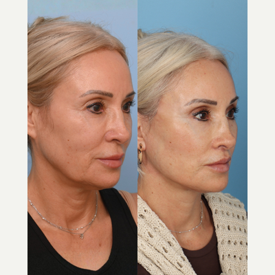 55-64 year old woman treated with Deep Plane Facelift, Neck Lift, Brow Lift, Double Eyelid Surgery, Lip Lift, Facial Fat Transfe - In her late 50s, and refining what already feels like her with more support, structure, and vitality.With the Artiste Lift, the intention isnt to change your face, but to restore it by lifting deeper structures while preserving the skin for results that feel natural, balanced, and effortless. Her result is subtle but powerful: lifted contours, softened features, and a refreshed appearance without visible signs of intervention.Full procedure includes a: Preservation Deep Plane Facelift  Deep Vertical Neck Lift  Upper Blepharoplasty  Temporal Lift  Subnasal Lip Lift  Full Face Fat TransferTimeless, confident, and authentically her. Save and share this post for reference or share with someone exploring facial rejuvenation!