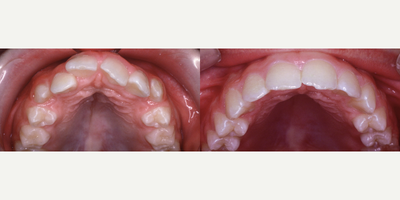 25-34 year old man treated with DNA Appliance - DNA appliance work before and after pictures.