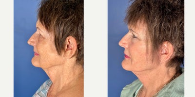 65-74 year old woman treated with Facelift, Eyelid Surgery - Patient underwent a Face and Neck Lift with Upper and Lower Eyelids Procedure. Post-Op photo taken at 6 weeks.