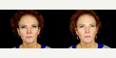 60 year old woman treated with Thread Lift - 60 year old woman treated with Thread Lift. Photos depict before and 3 months after 18 Novathreads