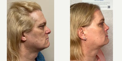 45-54 year old woman treated with Forehead Reduction, Brow Lift, Septoplasty, Rhinoplasty, Lip Lift, Lip Surgery, Adam's Apple R - This is a lady who underwent forehead feminization, septorhinoplasty, lip lift with augmentation, and chin feminization.