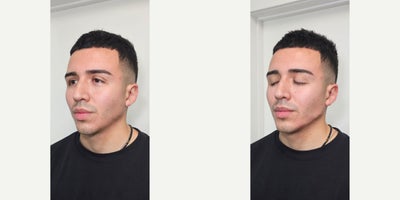 25-34 year old man treated with Chin Filler - Jawline and chin filler