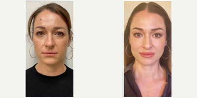 25-34 year old woman treated with Juvederm, Restylane Contour, Cheek Fillers, Lip Fillers - CHEEK, MIDFACE CONTOURING AND LIP FILLER ENHANCEMENT