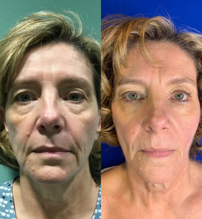 55-64 year old woman treated with Thread Lift - Patient received threads in face to lift skin and achieve a younger appearance without surgery.