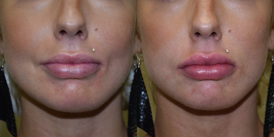 18-24 year old woman treated with Lip Augmentation - 1cc Juvederm Ultra Plus