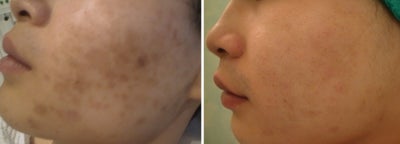 Green peel to hyper-pigmentation of cheek - Source: Omniderm