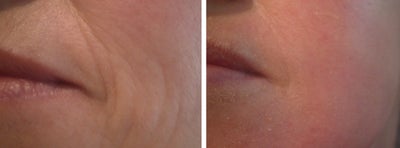 Green Peel to Wrinkles on cheek - Source: Omniderm