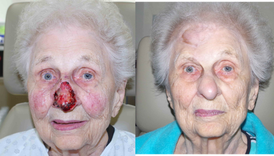 75 and up year old woman treated with Facial Reconstructive Surgery - 89 year old female received a MOHs repair; photos depict the patient's results 5 months post-op.