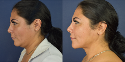 35-44 year old woman treated with Neck Lift, Buccal Fat Removal, Chin Liposuction, Micro Botox - This female patient treated with Deep Necklift, buccal fat removal and facial lipo. She has a jowl line reshaping and more facial definition.