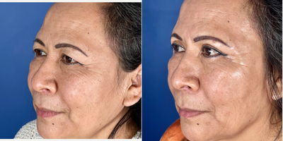 55-64 year old woman treated with Eyelid Surgery - PROCEDURE DETAILSUpper Eyelid surgery (Upper Blepharoplasty)After photos taken @ 3 monthsPATIENT INFOSex: FemaleAge: 56