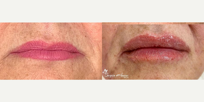 55-64 year old woman treated with Revanesse - Beautiful lips created with the combination of Juvederm Volbella and Versa.