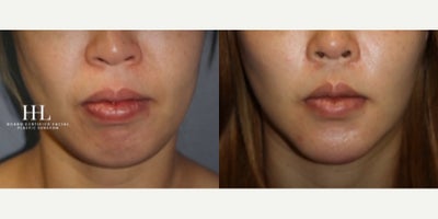 Woman treated with Jaw Reduction - Woman treated with Jaw Reduction
