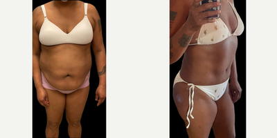 45-54 year old woman treated with Tummy Tuck, Liposuction, Mommy Makeover - 46 y.o female who underwent abdominoplasty which entailed removal of abdominal laxity, repair of diastasis recti, repositioning of umbilicus and liposuction of abdomen, flanks and back . At 3 months post-op, her  contours are significantly improved.