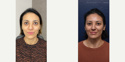 45-54 year old woman treated with Sculptra, Juvederm, Dysport - Woman in her 40s. Healed results over 2 years. Areas treated: temples, midface, undereye, lips, chin shadow, preauricular region. A combination of Sculptra, hyaluronic acid filler, and PRF were used. She has also received Dysport treatments 3x per year.