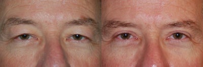 Eyelid, Male - 
	Eyelid, Male
