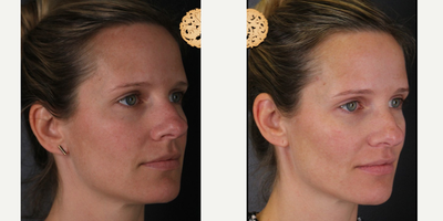 35-44 year old woman treated with Dermalinfusion - Dermal Infusion - Before & After