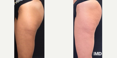45-54 year old woman treated with Venus Legacy - Impressive results addressing skin texture and tone with Venus legacy over 8 treatment series.