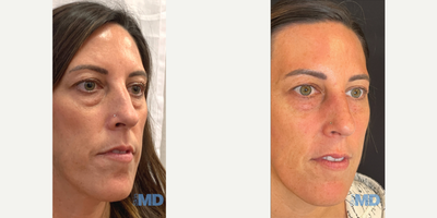 35-44 year old woman treated with AccuTite, Morpheus8 - This lovely patient took years off her appearance by addressing her undereye area with AccuTite and Morpheus8 at Skin MD.