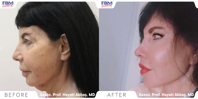45-54 year old woman treated with Lower Facelift, Neck Lift, Double Eyelid Surgery, Eyelid Surgery, Canthoplasty, Rhinoplasty - This patient came a year ago, she had a double chin, and double eyelids, one year after a deep plane facelift & rejuvenation in addition to the rhinoplasty surgery. She is very happy with the outcome and she feels like was reborn again.