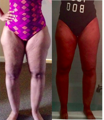 35-44 year old woman treated with Vaser Liposuction - vaser and body jet liposculpture of the thighs/legs in a patient with lipedema. see the transition from before, 2 weeks and 6 weeks after treatment.