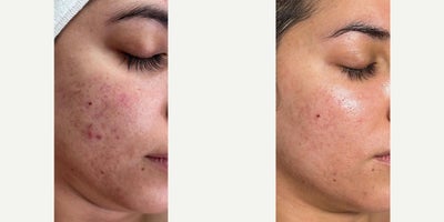 25-34 year old female treated with VI Peel, HydraFacial - This patient came in with active acne, scarring, and post-inflammatory hyperpigmentation. We treated her with a customized series of Vi Peels to resurface and brighten the skin, combined with HydraFacials for deep cleansing, hydration, and enhanced skin renewal.After treatment, she experienced:- Fewer acne breakouts- Smoother skin texture- Lightened pigmentation- A clearer, more radiant complexion