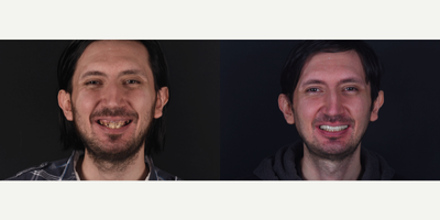 25-34 year old man treated with Dental Bone Graft, Dental Implants, Smile Makeover - Our patient had hopeless teeth in his upper jaw. Also high smile line was present which made the case difficult to achieve a good aesthetics. After digital analysis by the use of 3D CT, bone reduction, extraction of all hopeless teeth and placement of 8 implants was planned. After a 3 months of period, permanent fixed prosthesis has been delivered.