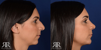 Chin Surgery - Chin Surgery