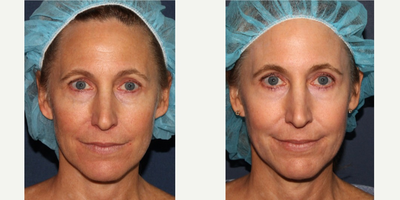 45-54 year old woman treated with Fraxel Repair - Fraxel Re:pair laser is used to improve the skin tone of a female patient.