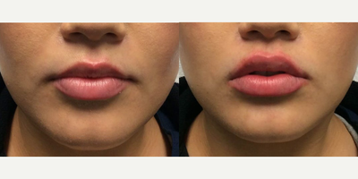 Woman treated with Juvederm, Lip Fillers - Woman treated with Juvederm, Lip Fillers