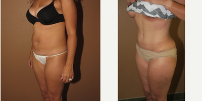 35-44 year old woman treated with Tummy Tuck - Abdominplasty (tummy tuck) and brazilian buttocks lift